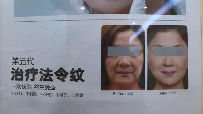 男子花17萬屁股整形后肛門功能受損