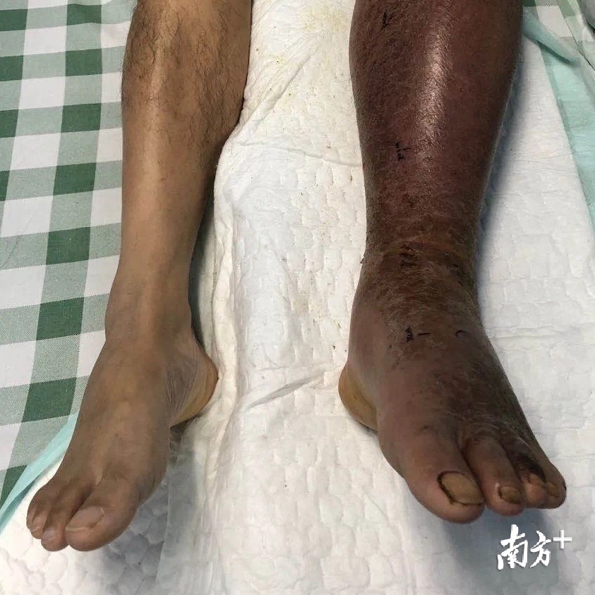 被蛇咬飲藥酒險斷臂