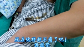 過度防曬致翻身骨折