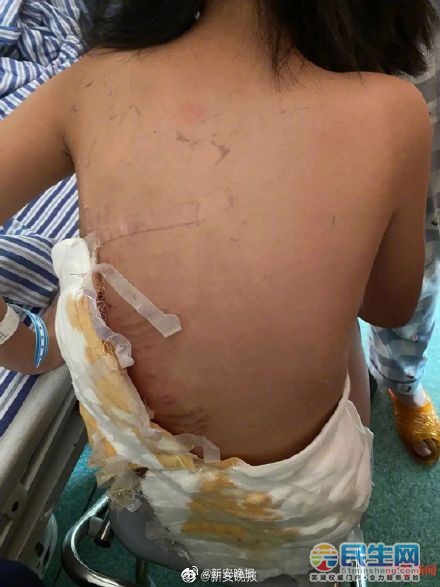 女童被狗撲咬受傷
