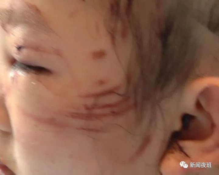 女童被狗撲咬受傷