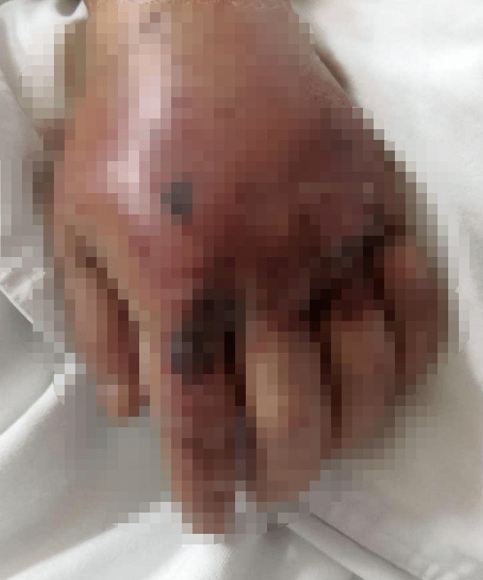 男子喂食人魚被咬掉手指無奈接腳趾