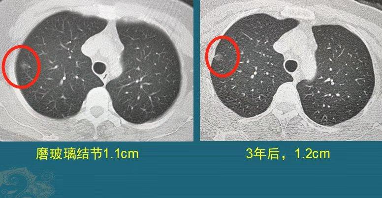 震驚！27歲女子肺結節沒在意 1年后確診肺癌，醫生痛心疾首這些信號別忽視！