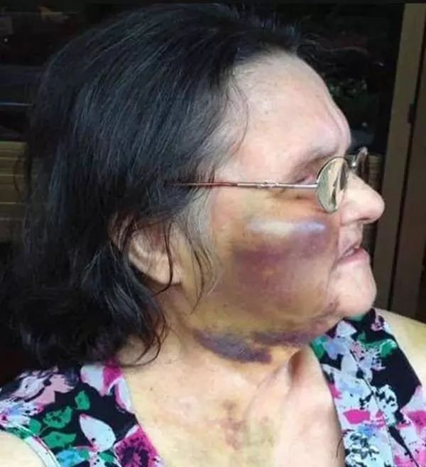 "護(hù)女被打成90歲腦齡"事件震驚全國誰該為這場悲劇負(fù)責(zé)？